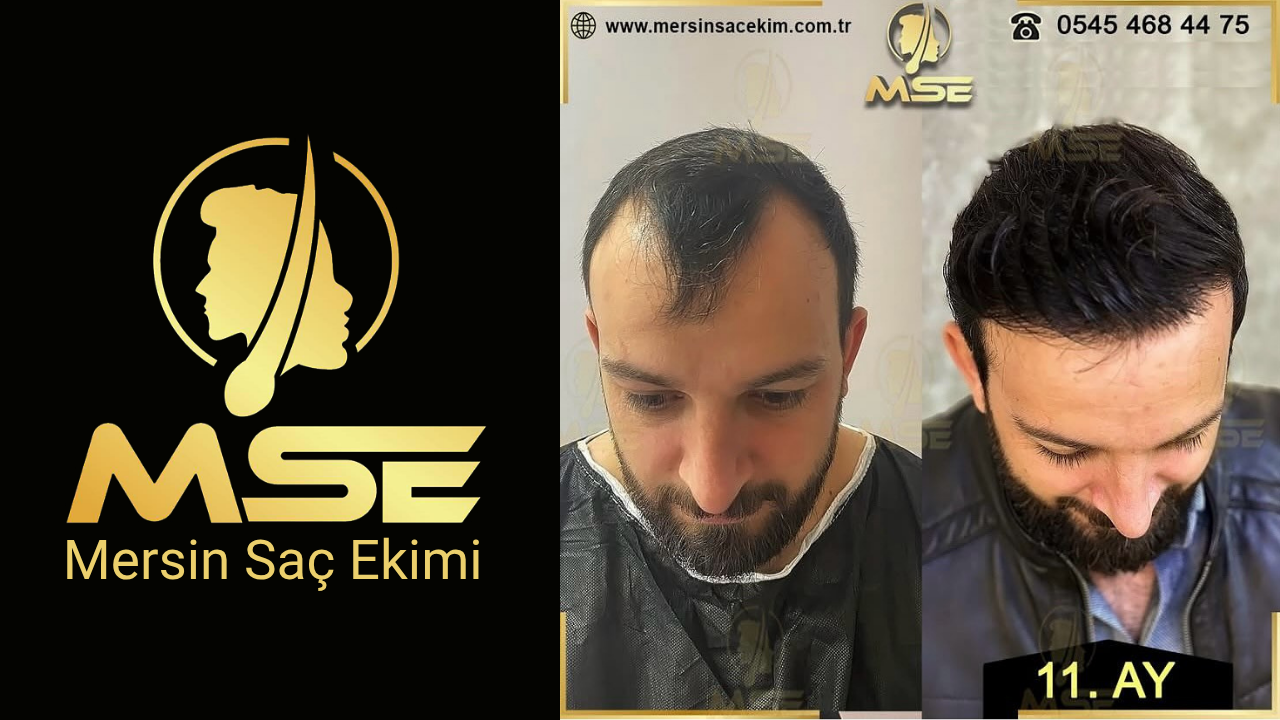 MERSİN SAÇ EKİMİ